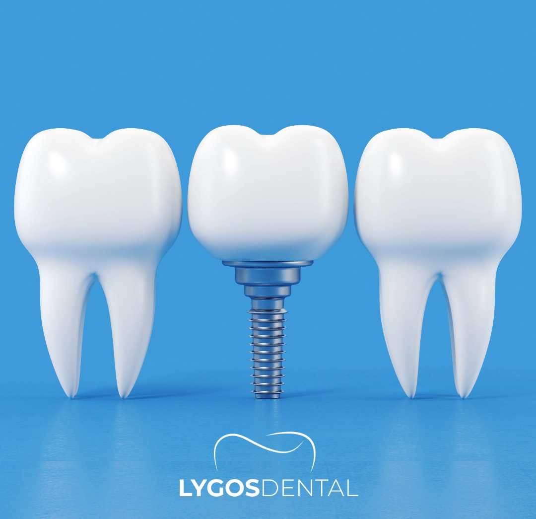 All-on-4 Dental Implants 12 Stages of All-on-4 Dental Implants Treatment
