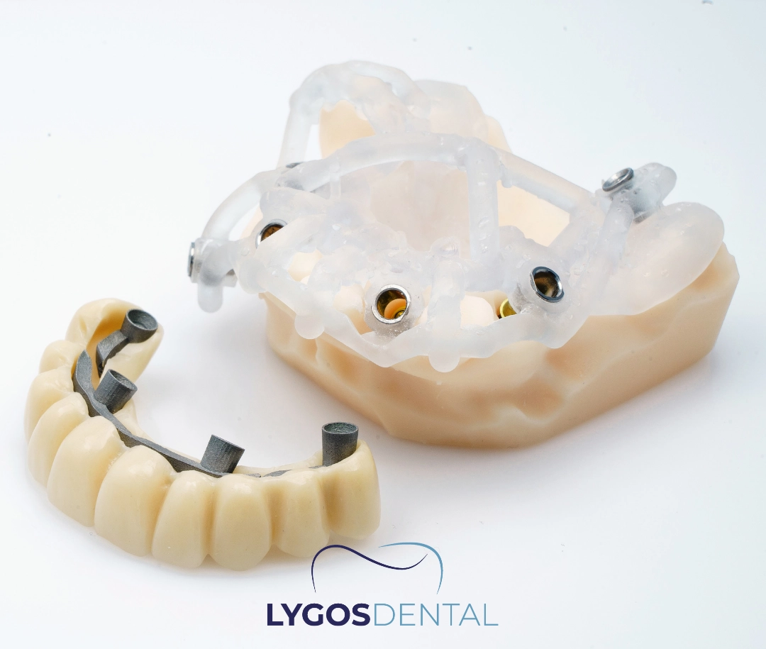 All-on-4 Dental Implants 11 What Are All-on-4 Dental Implants?