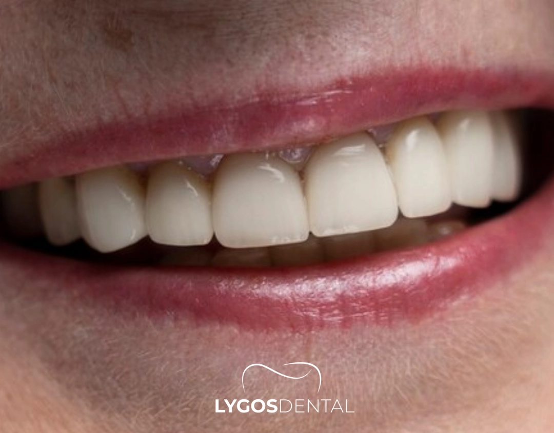 Tooth Erosion (Dental Erosion) | LYGS DENTAL 15 Erosion of Enamel on Teeth