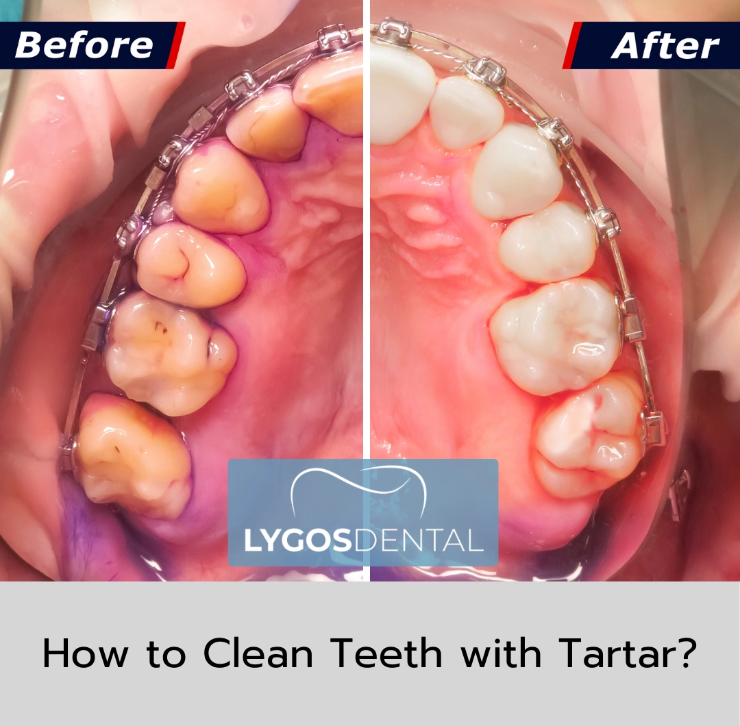 How to Brush Your Teeth? | LYGOS DENTAL 11 How to Clean Teeth with Tartar?
