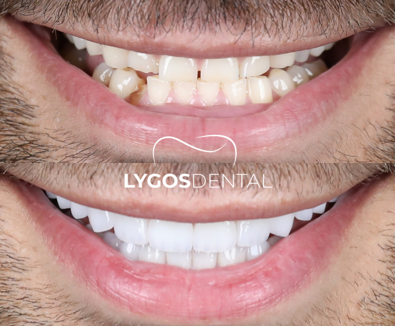 Dental Tourism in Turkey | LYGOS DENTAL 8 Öncesi & Sonrası Türkiye’de Diş Turizmi Sonuçları