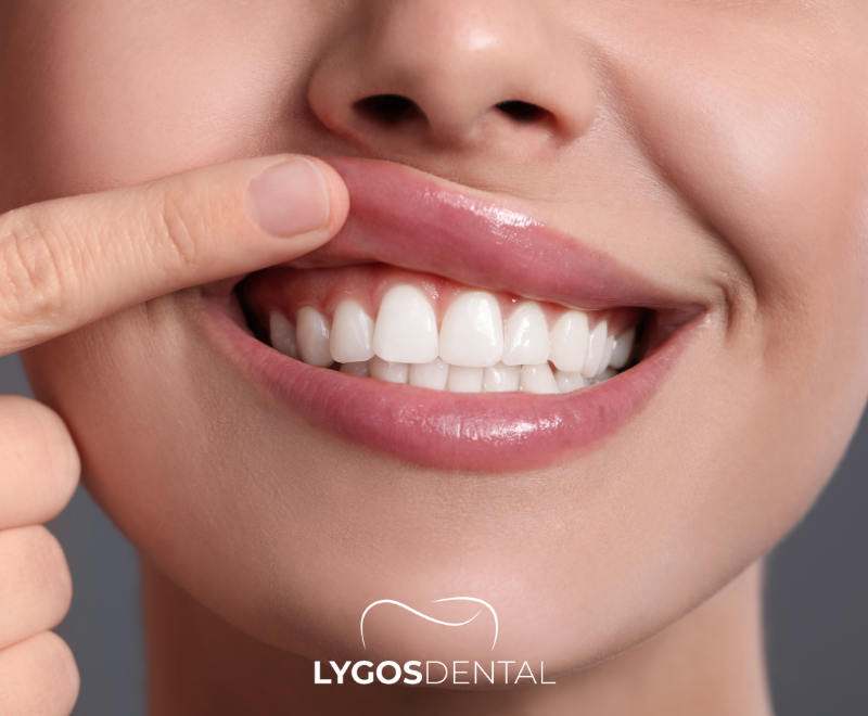 Gum Recession | LYGOS DENTAL 7 Gum Recession | LYGOS DENTAL