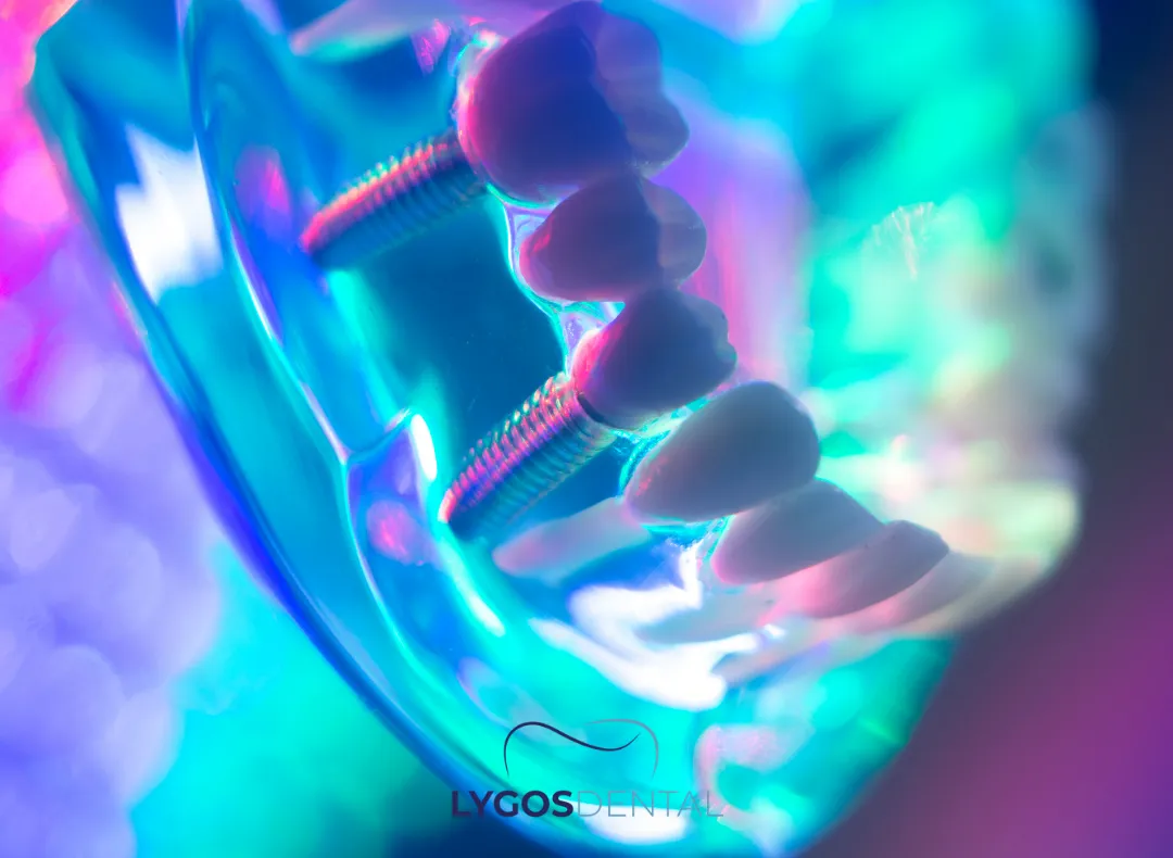 Oral and Maxillofacial Surgery | LYGOS DENTAL 2 What is Maxillofacial Surgery