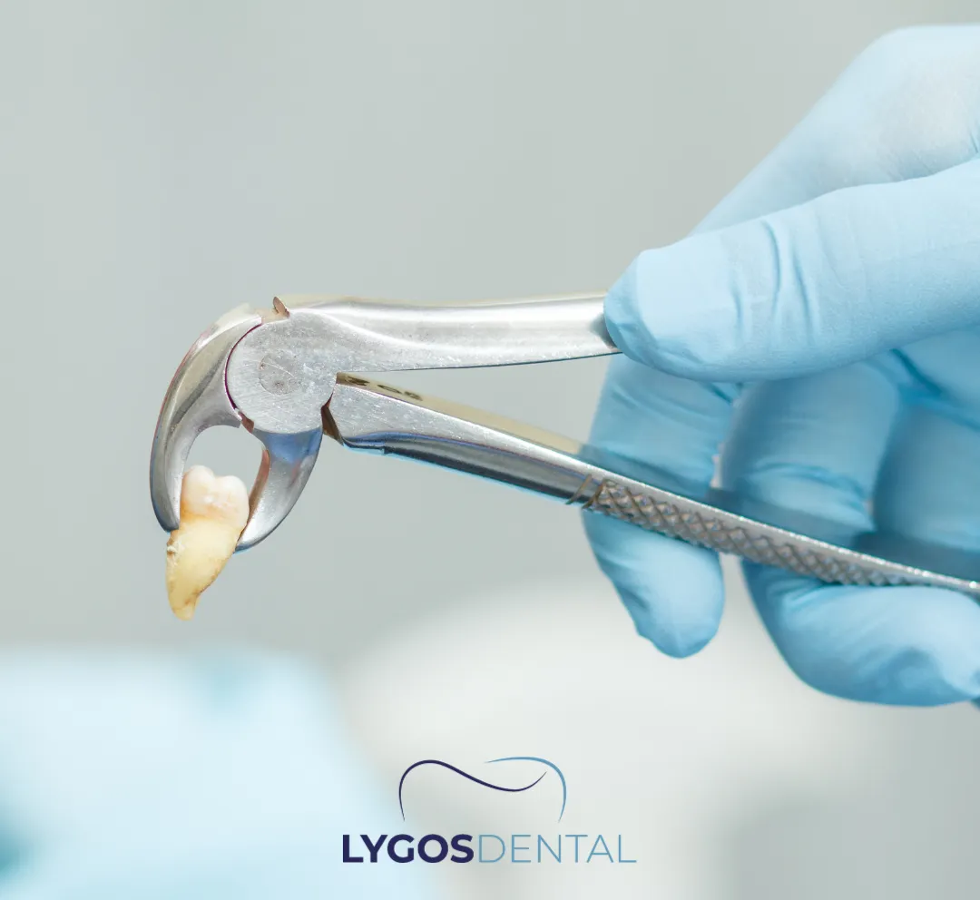 What is Tooth Extraction? | LYGOS DENTAL 3 What is Tooth Extraction