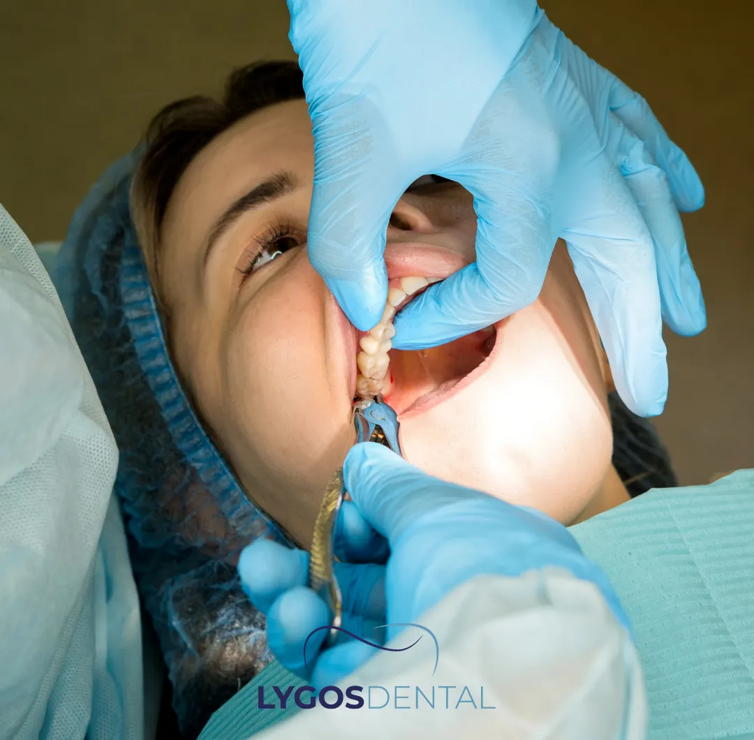What is Tooth Extraction? | LYGOS DENTAL 4 When is Wisdom Tooth Extraction Necessary