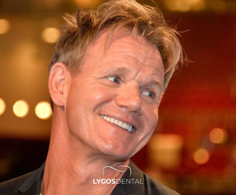 Gordon Ramsay Teeth Veneers | LYGOS DENTAL