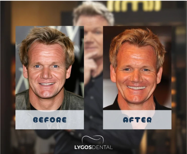 Gordon Ramsay Teeth Veneers | LYGOS DENTAL