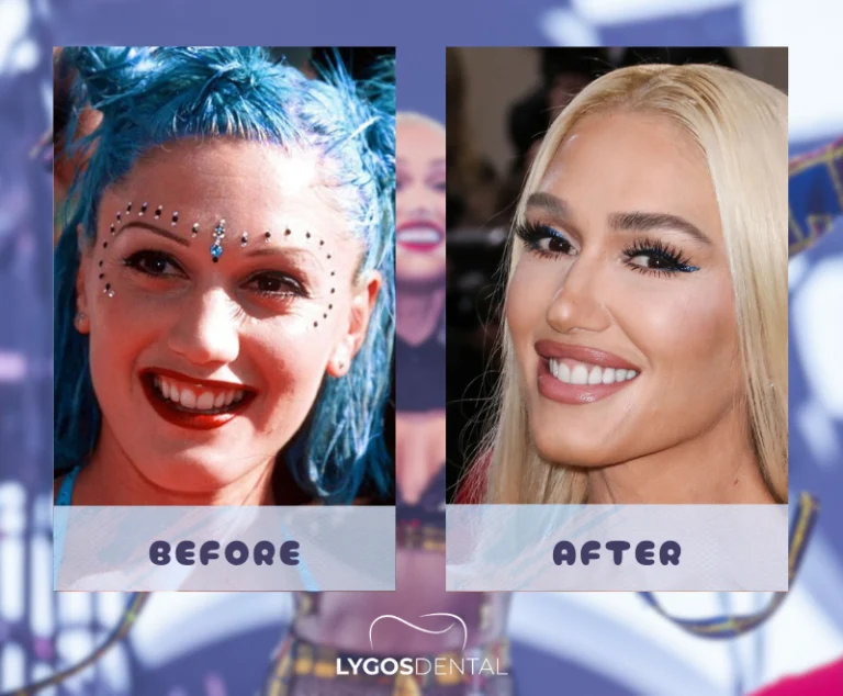 Gwen Stefani Diş Kaplamaları | LYGOS DENTAL