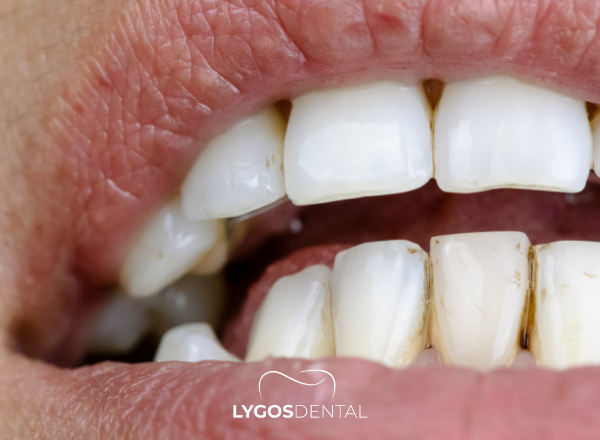 How to Remove Coffee Stains on Teeth | LYGOS DENTAL 1 How to Remove Coffee Stains on Teeth | LYGOS DENTAL