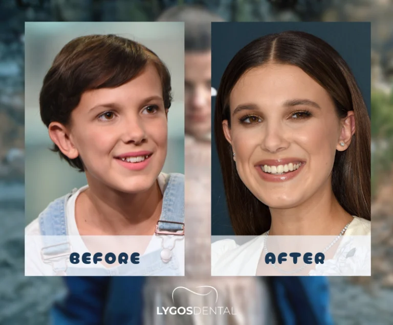 Carillas dentales de Millie Bobby Brown | LYGOS DENTAL 2 Carillas dentales de Millie Bobby Brown | LYGOS DENTAL
