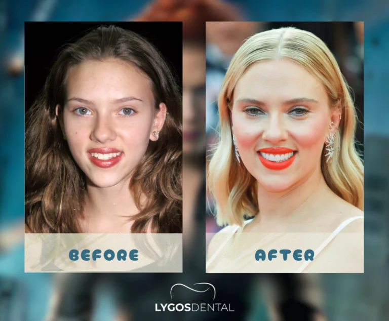 Scarlett Johansson Teeth Veneers | LYGOS DENTAL