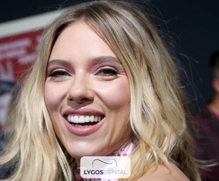 Scarlett Johansson Teeth Veneers | LYGOS DENTAL