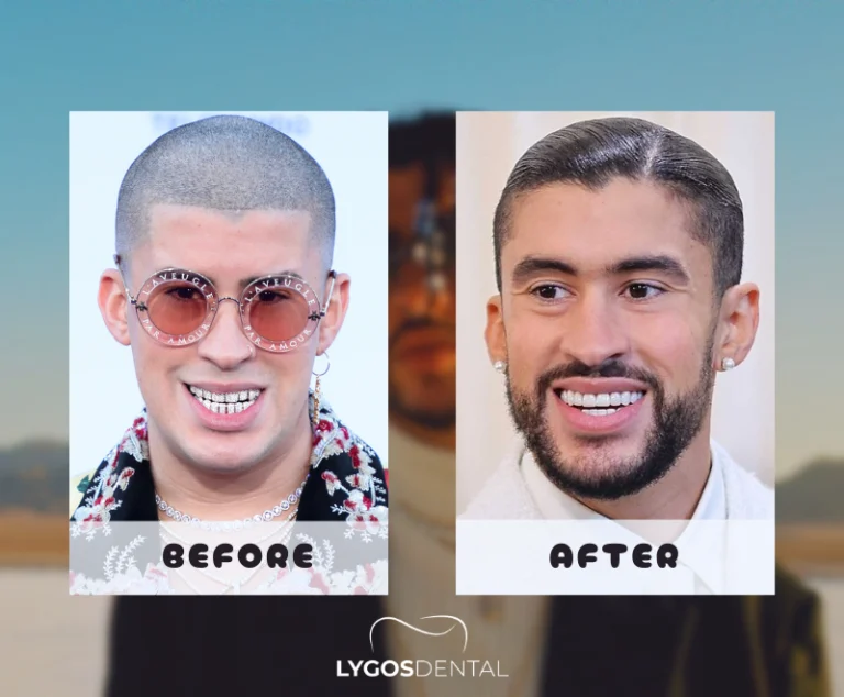 Benito Antonio Esthétique dentaire | LYGOS DENTAL 3 Benito Antonio Esthétique dentaire | LYGOS DENTAL