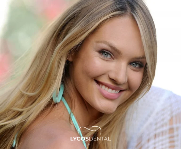 Candice Swanepoel Zahnveneers | LYGOS DENTAL