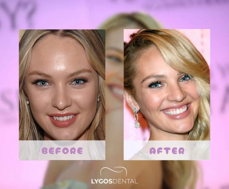 Candice Swanepoel Zahnveneers | LYGOS DENTAL