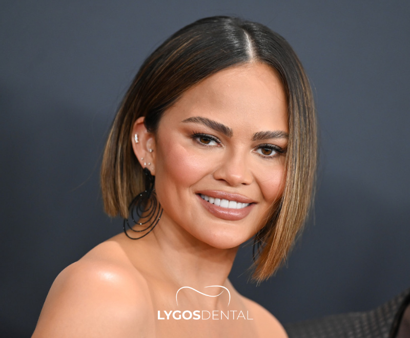 Chrissy Teigen Dental Aesthetics | LYGOS DENTAL 1 Chrissy Teigen Dental Aesthetics | LYGOS DENTAL
