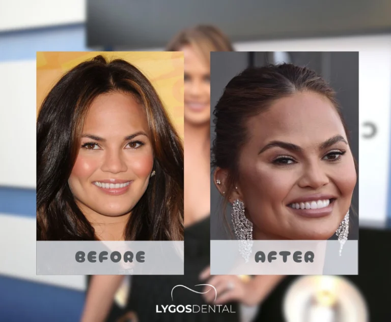 Chrissy Teigen Dental Aesthetics | LYGOS DENTAL 3 Chrissy Teigen Dental Aesthetics | LYGOS DENTAL