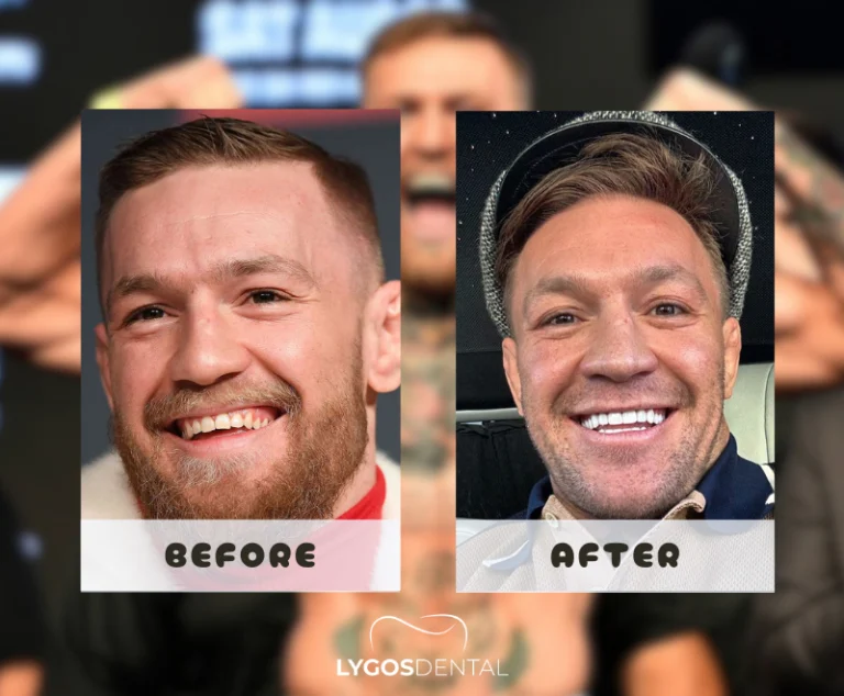 Connor McGregor Diş Kaplamaları | LYGOS DENTAL
