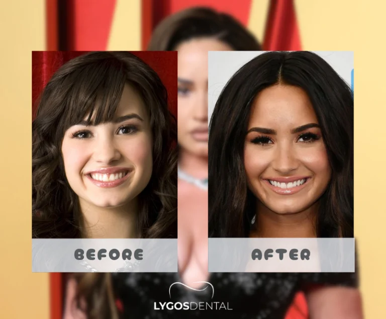 Demi Lovato Dental Aesthetic | LYGOS DENTAL
