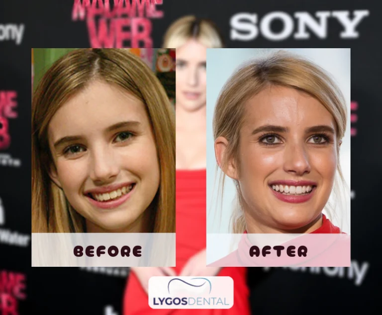 Emma Roberts Dental Aesthetic 3 Emma Roberts Dental Aesthetic