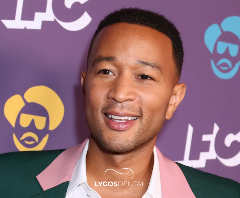 John Legend Teeth Veneers