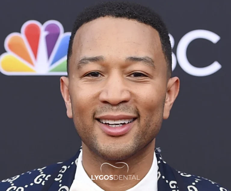 John Legend Teeth Veneers