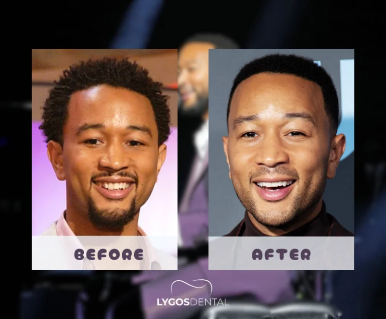 John Legend Teeth Veneers