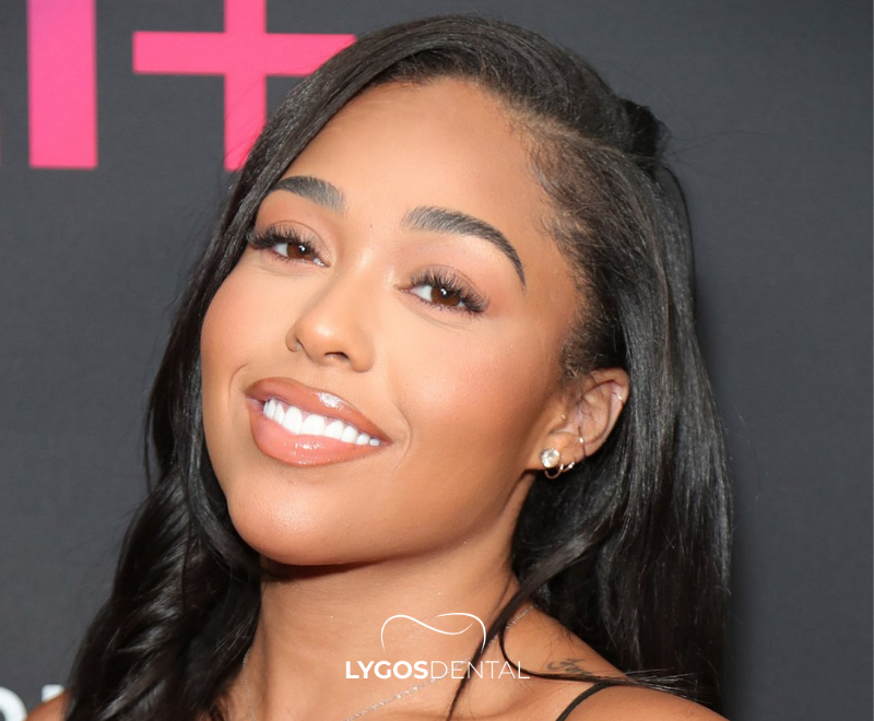 Jordyn Woods Dental Aesthetic