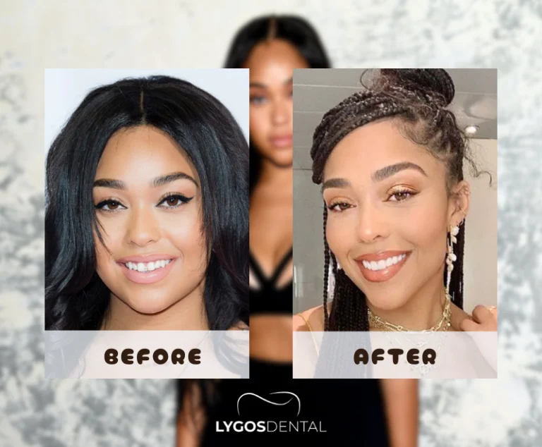 Jordyn Woods Dental Aesthetic