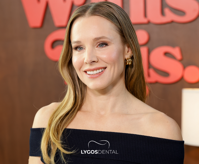 Kristen Bell tandheelkundige facings | LYGOS DENTAL
