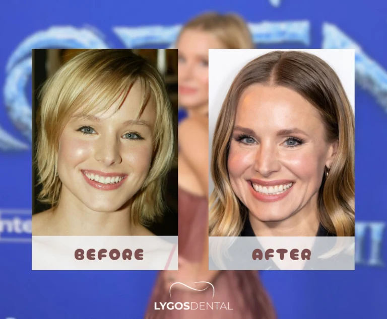 Kristen Bell tandheelkundige facings | LYGOS DENTAL