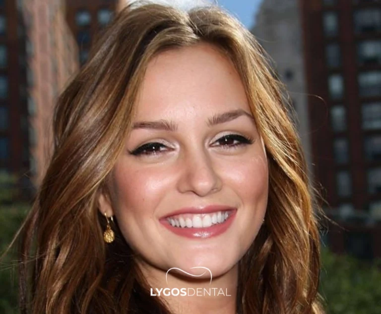 Leighton Meester Tandheelkundige esthetiek | LYGOS DENTAL 1 Leighton Meester Tandheelkundige esthetiek | LYGOS DENTAL