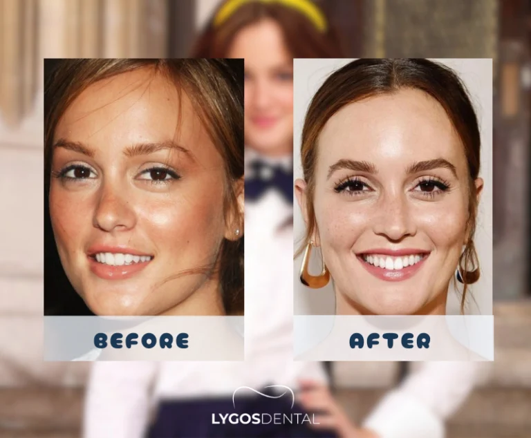 Leighton Meester Tandheelkundige esthetiek | LYGOS DENTAL 2 Leighton Meester Tandheelkundige esthetiek | LYGOS DENTAL