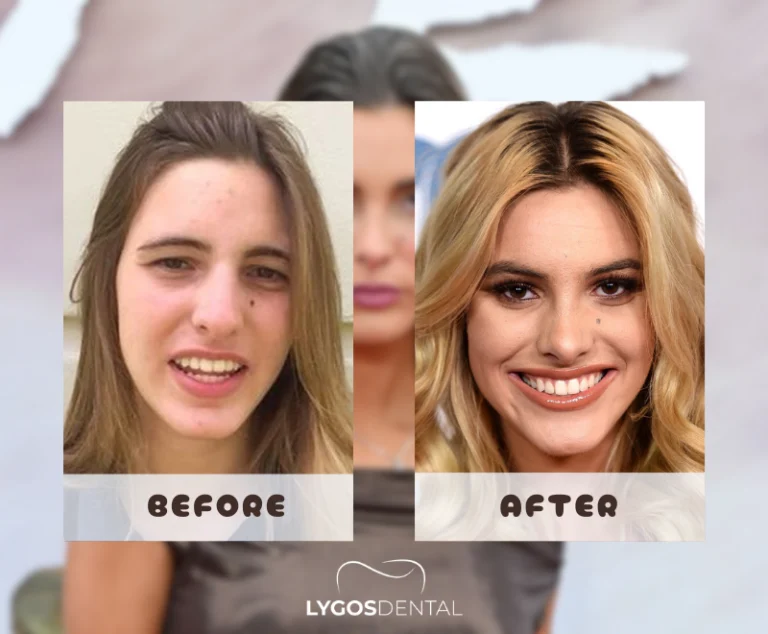 Lele Pons Dental Aesthetics | LYGOS DENTAL