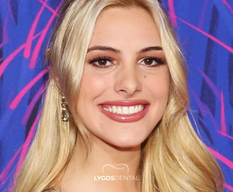Lele Pons Dental Aesthetics | LYGOS DENTAL