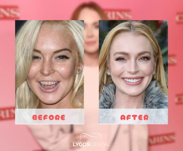 Lindsay Lohan Diş Estetiği | LYGOS DENTAL