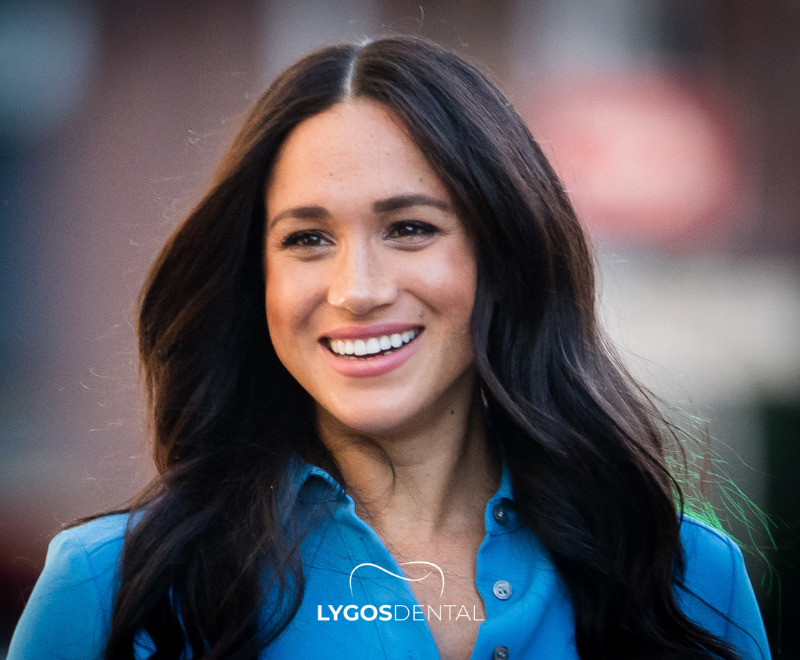 Meghan Markle Dental Aesthetics | LYGOS DENTAL