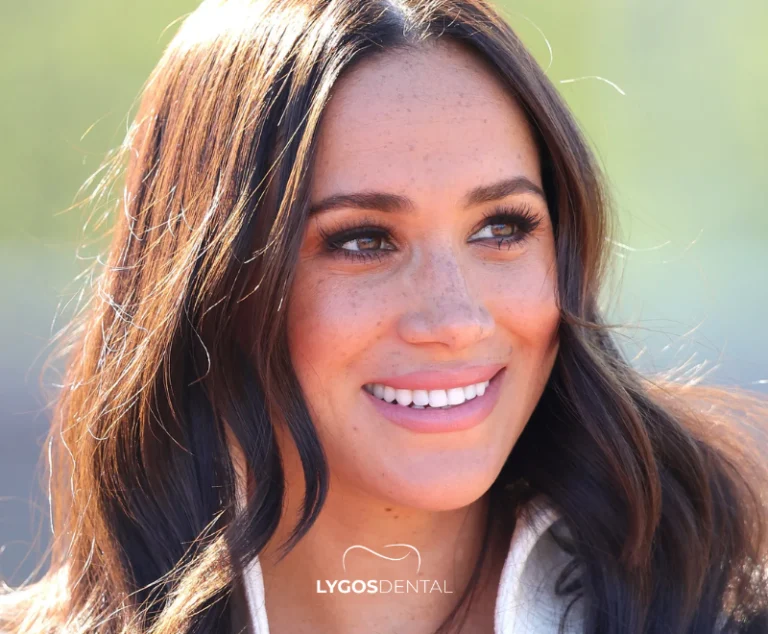 Meghan Markle Dental Aesthetics | LYGOS DENTAL