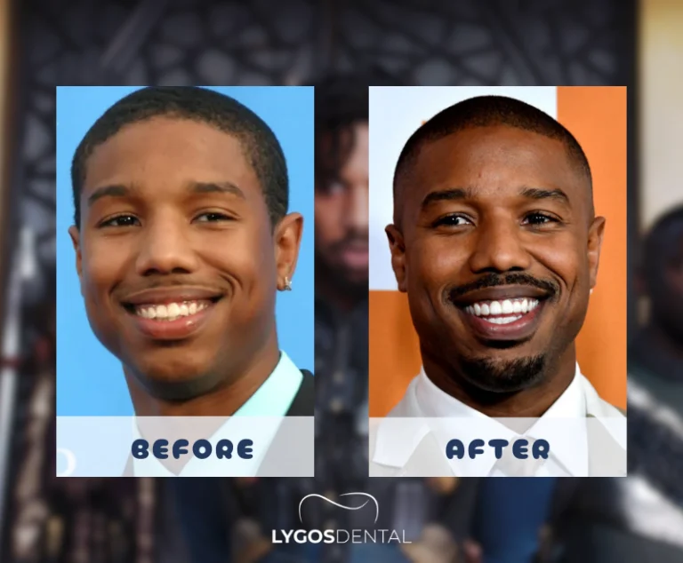 Michael B. Jordan Teeth Veneers 3 Michael B. Jordan Teeth Veneers