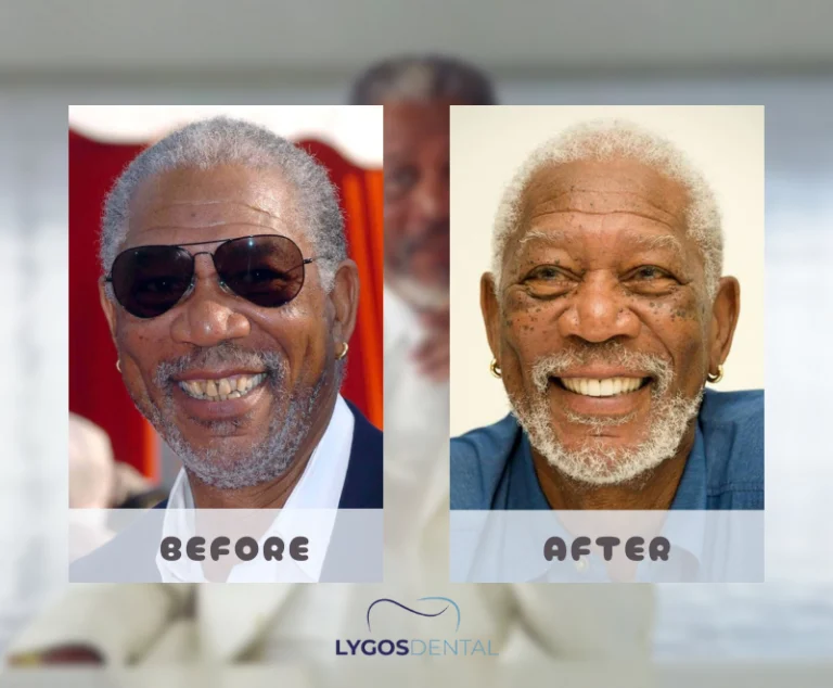 Morgan Freeman Dental Aesthetic