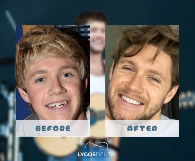 Niall Horan Dental Aesthetics | LYGOS DENTAL