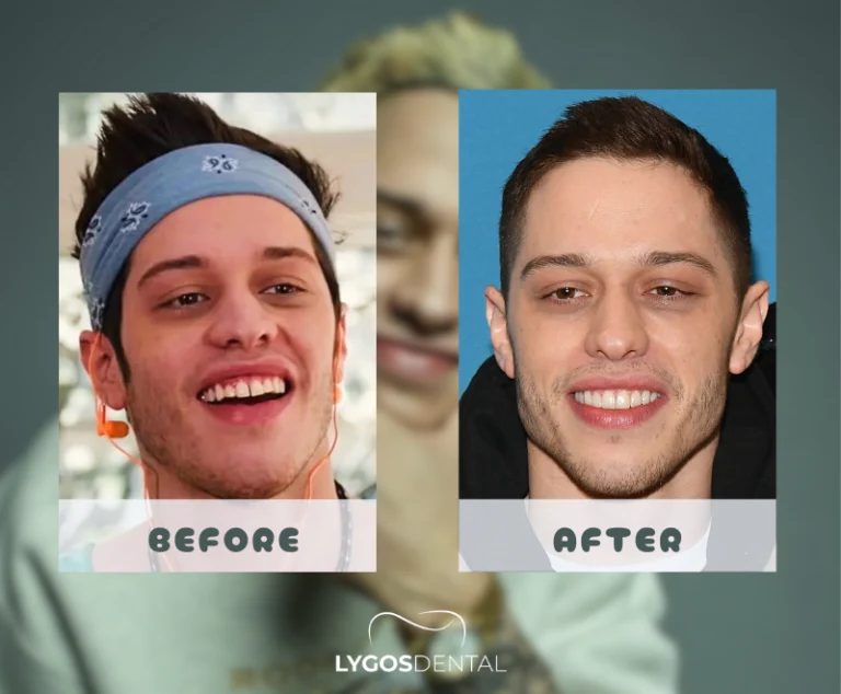 Pete Davidson tandheelkundige facings | LYGOS DENTAL 2 Pete Davidson tandheelkundige facings | LYGOS DENTAL