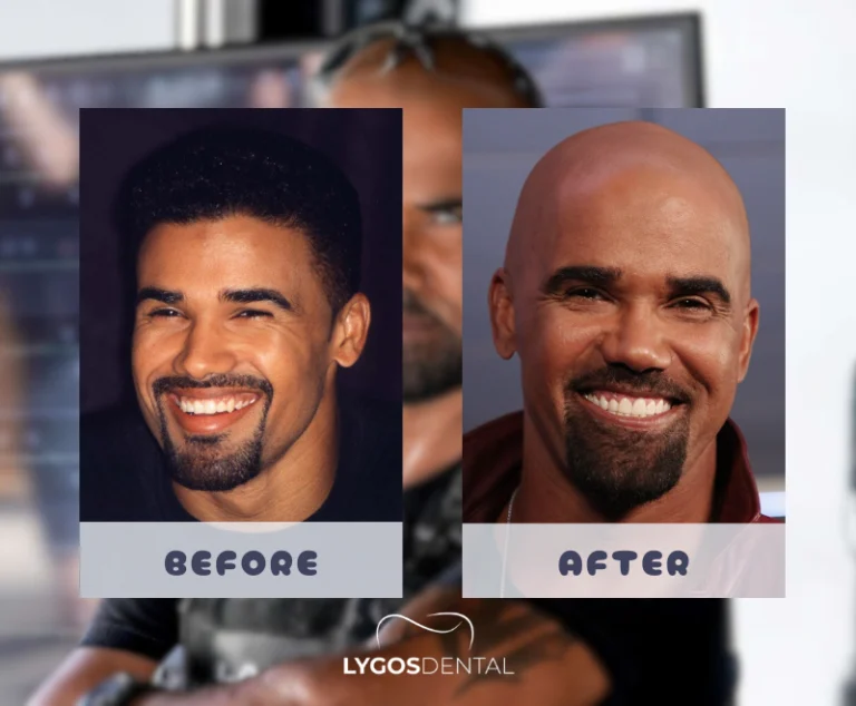 Shemar Moore Teeth Veneers