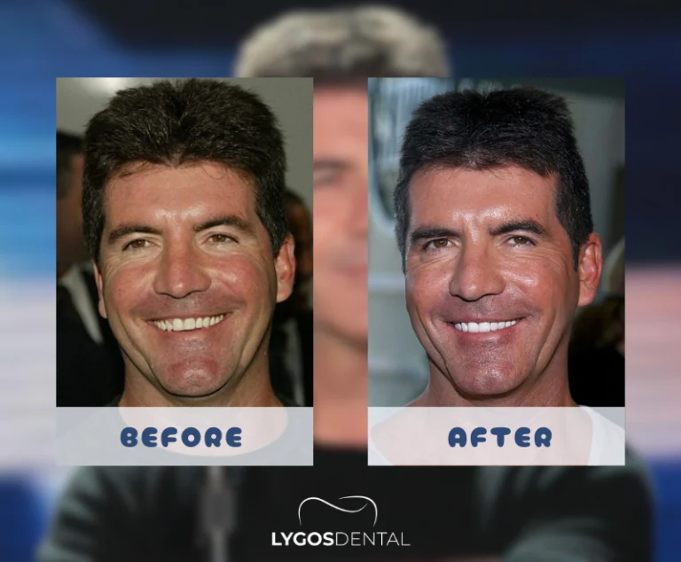 Simon Cowell Zahnästhetik | LYGOS DENTAL 2 Simon Cowell Zahnästhetik | LYGOS DENTAL