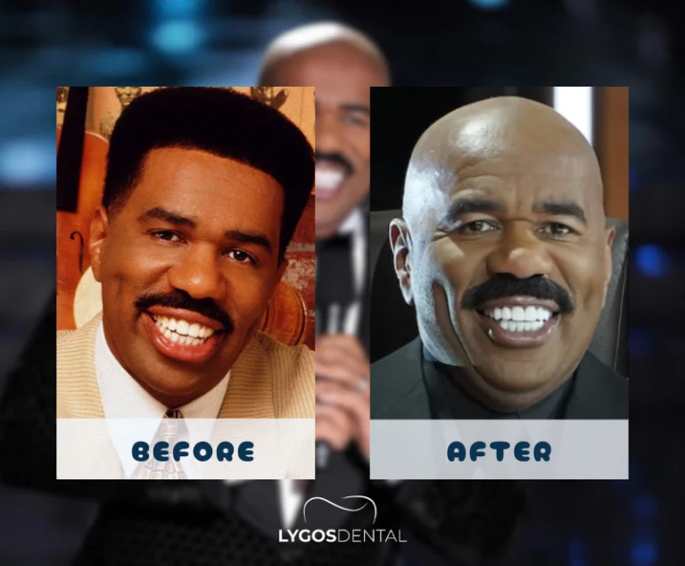 Steve Harvey Dental Aesthetic