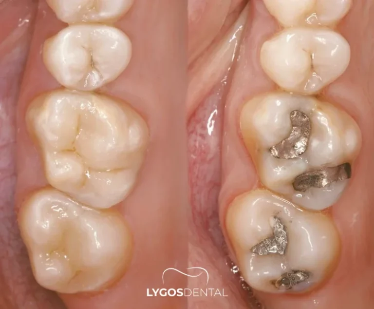 What is Amalgam Filling? 23 Differences Between Amalgam Fillings and Other Types of Fillings