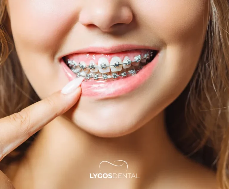 Gappy Teeth 20 Treatment Options for Gappy Teeth