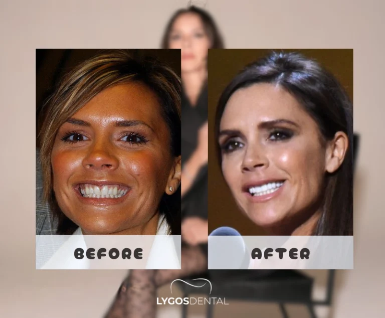 Victoria Beckham Dental Aesthetic