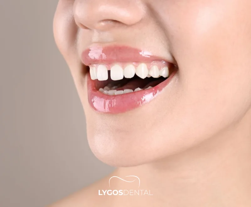 Gappy Teeth 19 What Are Gappy Teeth (Diastema)?