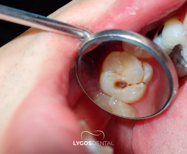 Wat veroorzaakt een tandcyste?